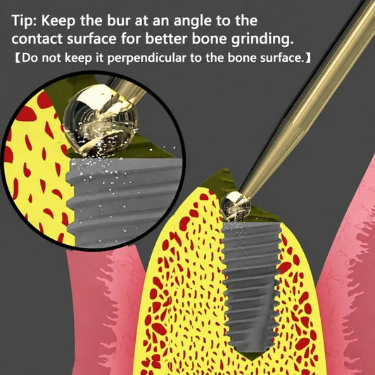 How High Is the Success Rate of Dental Bone Grafting - eedasdent