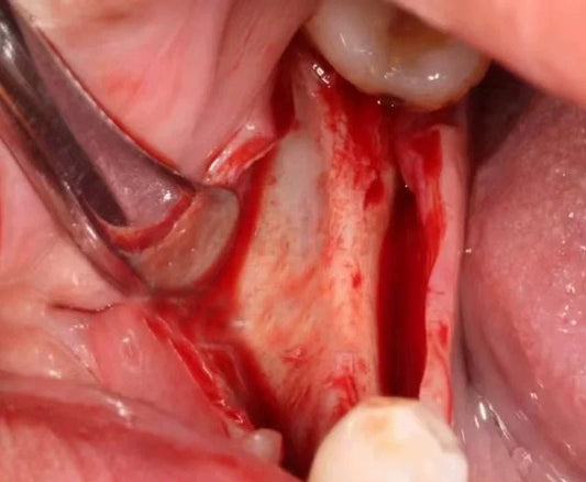 How Long Does a Dental Bone Graft Take to Heal - eedasdent