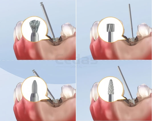 How to Use a Titanium Brush for Implant Surface Cleaning - eedas.com
