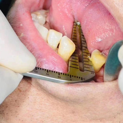 Dental Implant Positioning Guide Set - eedasdent