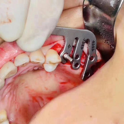 Dental Implant Positioning Guide Set - eedasdent